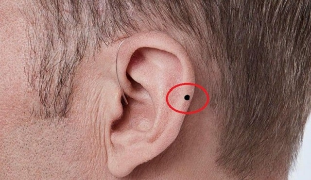 Ảnh 2: Nốt ruồi ở vành tai