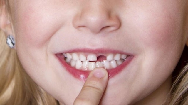 Ý nghĩa và những con số may mắn khi mơ thấy gãy răng